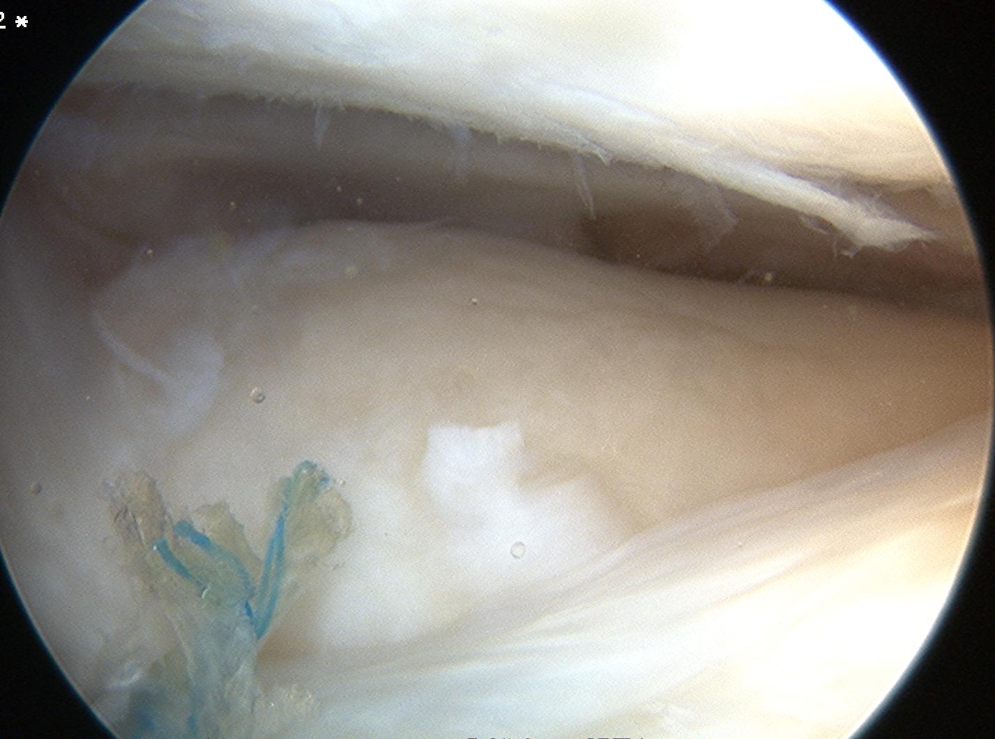 Anterior Horn Tear Final Repair